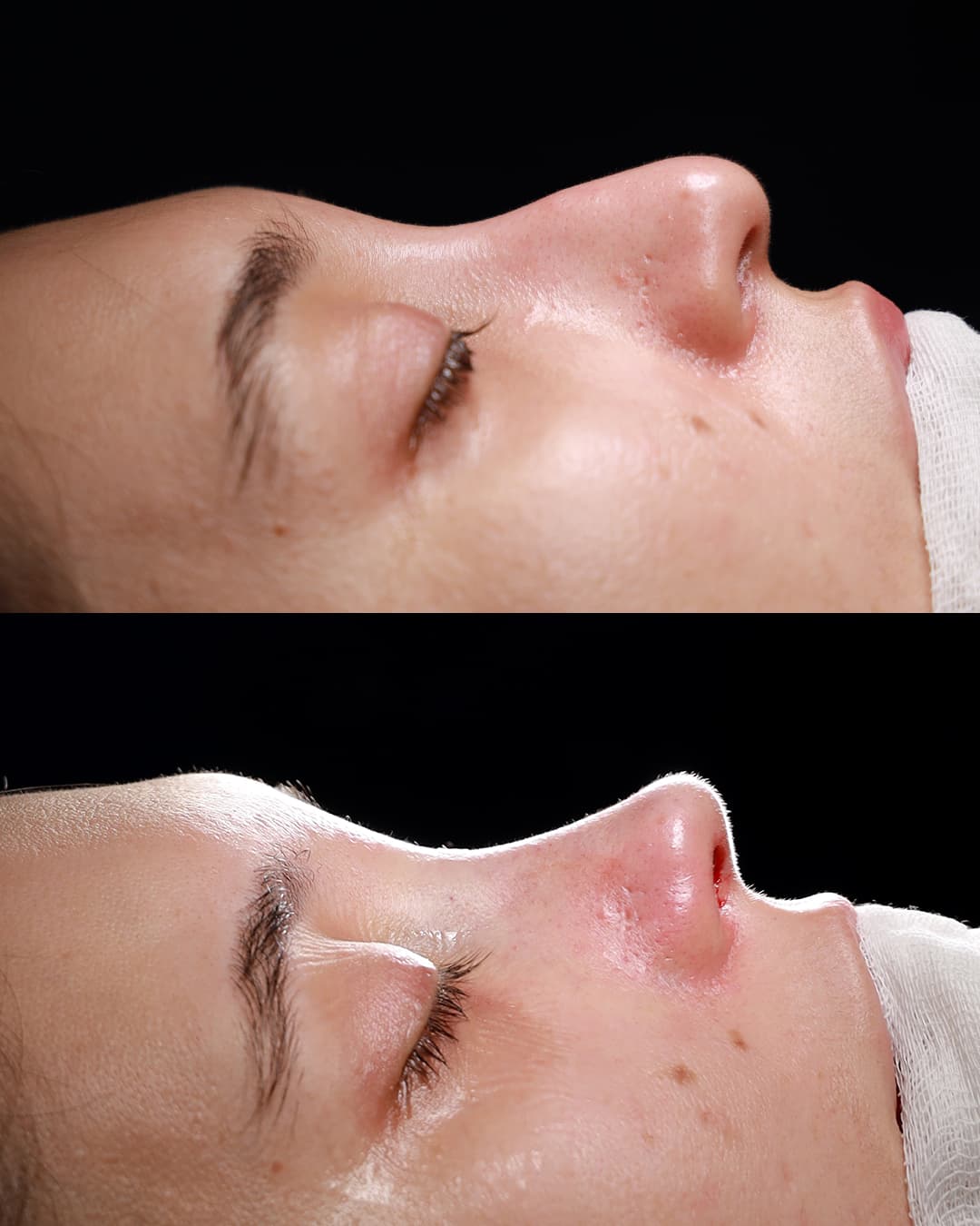 Primary Rhinoplasty Patient 5