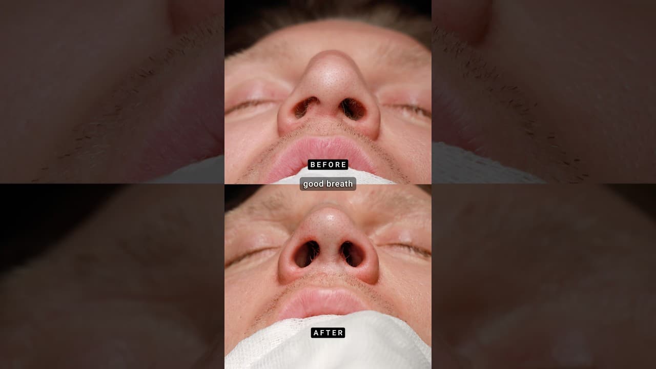 🥊 A Famous Boxer from Switzerland 🇨🇭 — Primary Male Teorhinoplasty